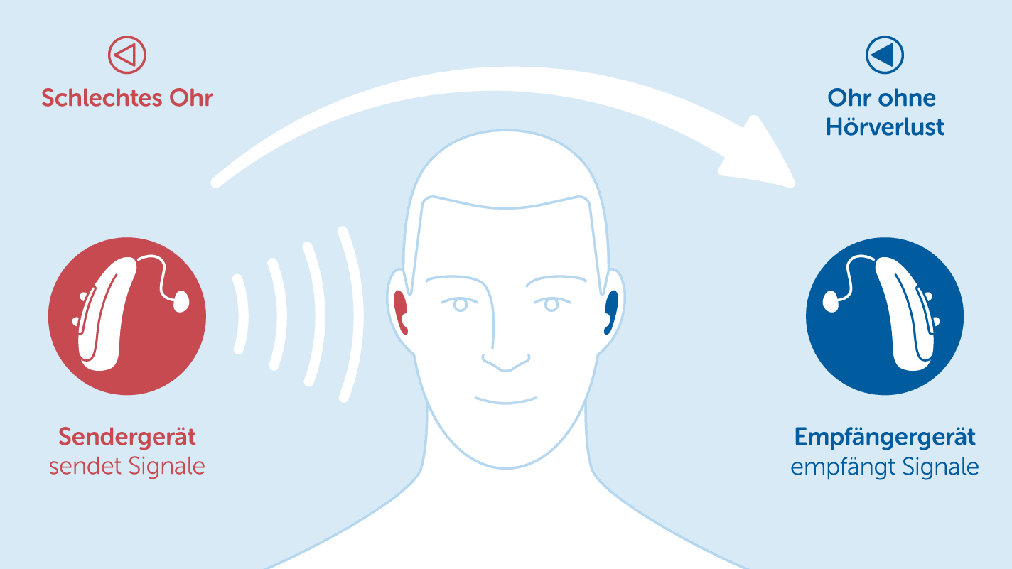 veranschaulichung eines cros hörgeräts